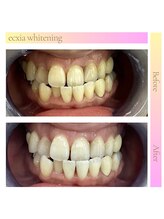 エクシアホワイトニング 浜松店/ホワイトニングビフォーアフター