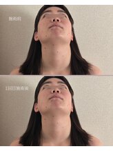 オラ(Ola)/30代/1回目施術後