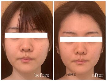 メゾンリュバン 天王寺(Maison Ruban)/小顔矯正