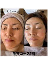 ミヤビ(MIYABI)/毛穴コース