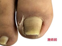 レフス 北参道店(REFUSS)/巻き爪矯正