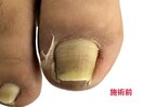 巻き爪矯正