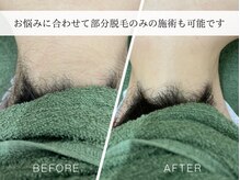 カスミ板橋ベルミーランド/部分脱毛