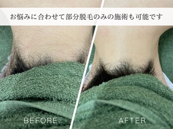 カスミ板橋ベルミーランド/部分脱毛