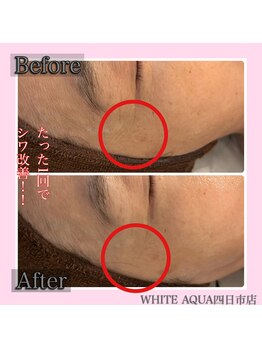 ホワイトアクア 四日市店(WHITE AQUA)/ララピール四日市/水光肌