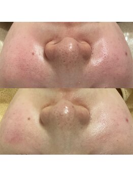 アミュレット(amulette)/赤み肌も1回で透明感のある肌へ