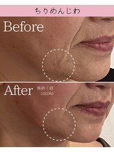 ココロ(COCORO)/深いほうれい線も！１回