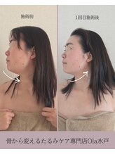 オラ(Ola)/30代/1回目施術後