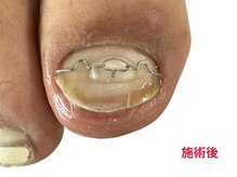 レフス 北参道店(REFUSS)/巻き爪矯正