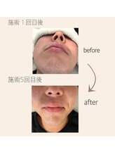 リアリ(Riali)/ヒゲ脱毛