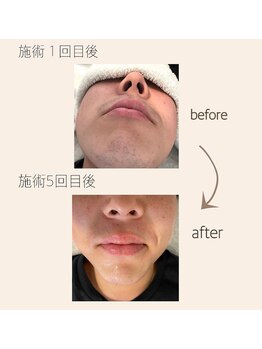 リアリ(Riali)/ヒゲ脱毛