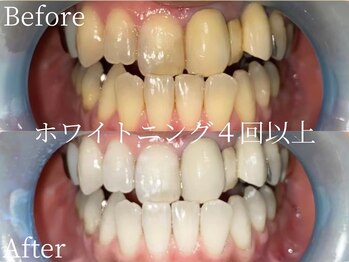 ミスティア(mistia)/セルフホワイトニング 4回以上