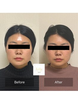 リリー(Lily)/ビフォーアフター