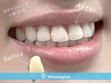 ホワイトニングカフェ 神戸元町店(WhiteningCafe)/◎歯のホワイトニング施術写真◎