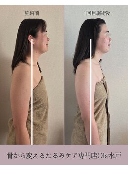 オラ(Ola)/30代/1回目施術後