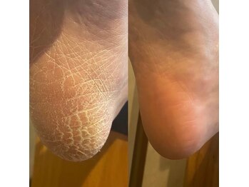フッティーナNs＋【巻き爪/フットケア/魚の目/タコ/足裏ケア】【8月中旬OPEN(予定)】の写真/【他店で改善しなかった方へ】肥厚爪・変形爪もお任せ！足専門店ならではの熟練技術で徹底サポート★