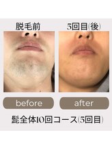 レア(LEA)/【メンズ】髭脱毛（頬～顎裏）