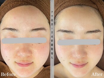 アール アンド ビューティーサロン(Ｒ＆ BeautySalon)/小顔集中