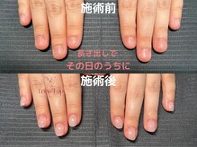 ツリートップ(Tree Top)/深爪矯正長さ出し