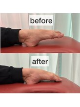 たんぽぽ整骨院鍼灸院/バレエ整体：甲出し