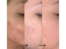 サロン ド ベル(Salon de Belle)/陶肌トリートメント後のお肌♪