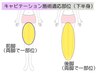 【美脚/美尻】美骨盤矯正+痛みの少ないキャビ3部位¥4980【全額返金保証】