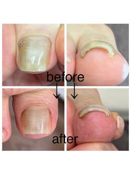 カラーホリック ネイルスパ(Colorholic Nailspa)/巻き爪補正