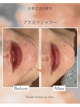 ラシック 加古川店(La chic.)/ゆらぎ肌を鎮静