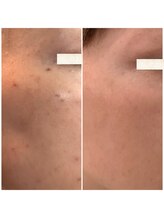 ビースキン(be-skin)/シミケアbefore→after