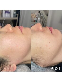 イクスト 吉祥寺(IKUST)/【フェイシャルワックス/脱毛】