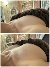 スマイルクルー(SmileClue)/小顔６０分の初回の変化