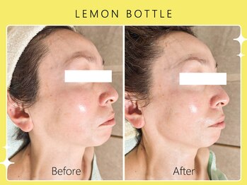 ハノハノ 八代店(HANO HANO)/小顔コルギ×レモンボトル☆