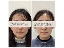 ハリナチュレ 札幌店の雰囲気（プライベート空間で美容鍼&小顔矯正【リフトアップ/むくみ】）