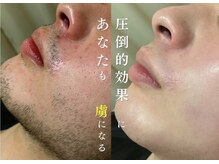 アルゴ 福津店(ALGO)の雰囲気（「青髭・カミソリ負けのお悩み」は大人気のひげ脱毛で解決♪）