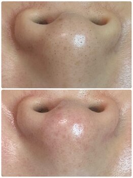 グリーン(green)/その毛穴埋もれ毛ちゃんかも?!