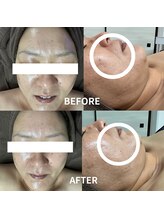 ビーンズ(BEANS)/LALAピール1回でこの凄さ！