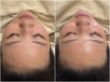 マヴィ 高槻店(MavY.)/お肌ツヤくすみ解消