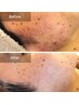 長年お悩みのニキビ悩みに鎮静ケアから★症状に合わせたカウンセリング/ケア