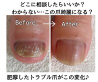 シーネイル(C Nail)