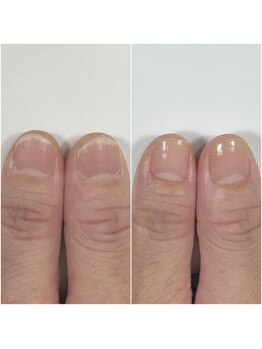 ギフト(GIFT)/自爪育成ネイルケア