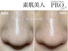 テテメルティ(te-te melty)/毛穴エクストラクションプロ