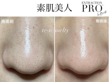 テテメルティ(te-te melty)/毛穴エクストラクションプロ
