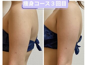 ヨサパーク すずのね(YOSA PARK)/姿勢と背中の見た目改善