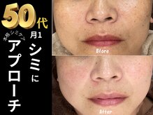 テセラ(Tethere)の雰囲気（目の周り濃いシミ、薄いシミ◎）