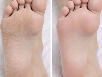角質ケア