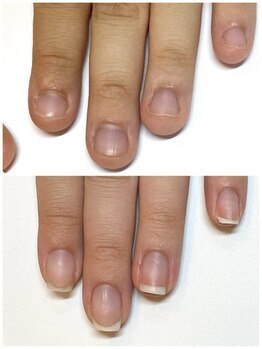 マリーロール 梅田店(Marie Laure)/自爪育成/深爪矯正/ネイルケア