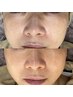 自然な若見え肌♪【40代～おすすめエイジング】剥離なしハーブトリートメント