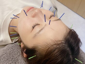 リボーン(reborn)/美容鍼