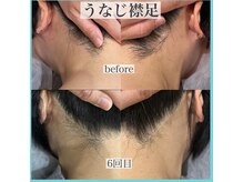 アクト クロ(ACT curro)/【うなじ襟足】脱毛施術例