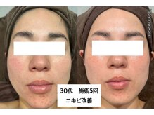 チャマ 徳島本店(CHAMA)/30代　WiQo水光ピール　施術5回